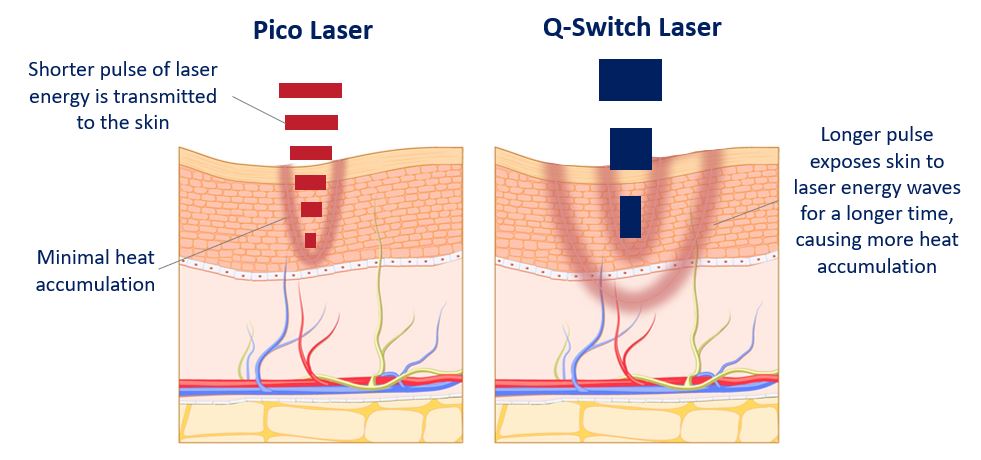 Skillnaden på Pico laser och Yag laser